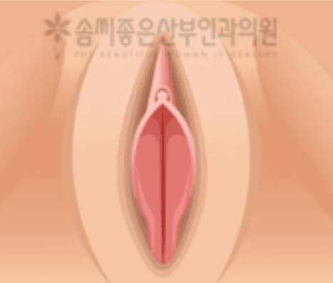 Labiaplasty Minora