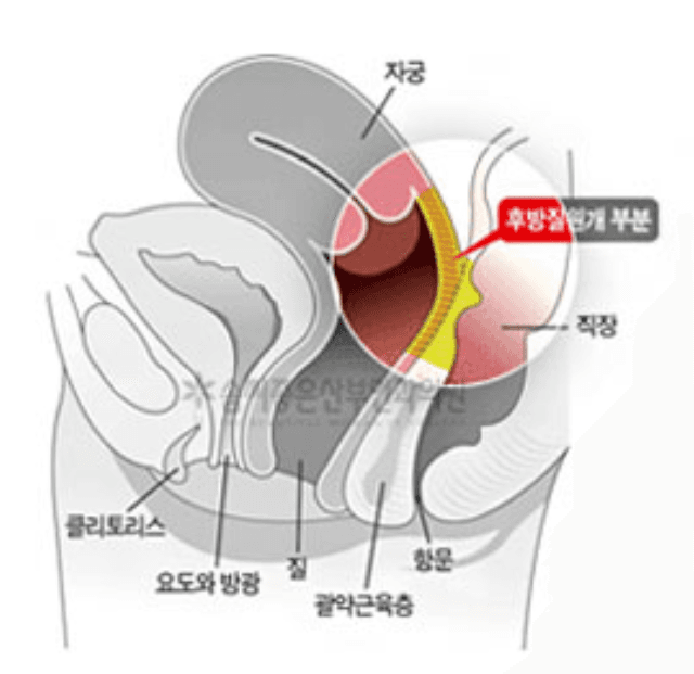 Posterior Colporrhaphy